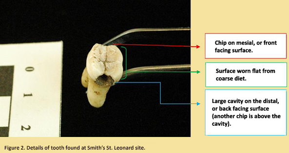 Image of found tooth with diagrams showing wear and decay of tooth.